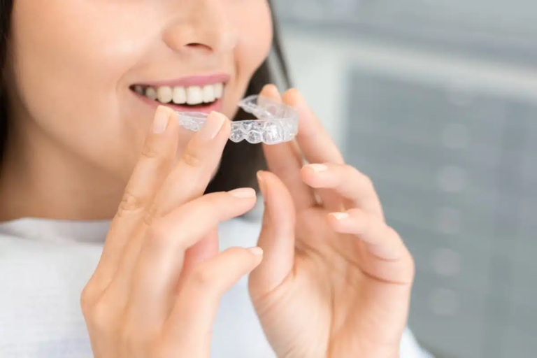 How Clear Aligners Can Straighten Your Teeth Without Braces